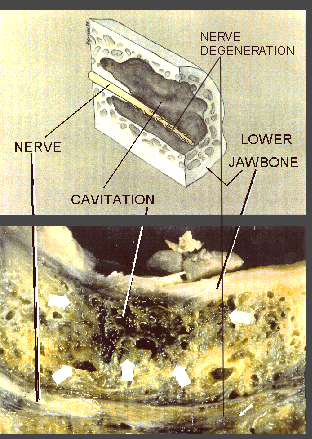 Root canals & cavitations - Living Network diagram of pain 